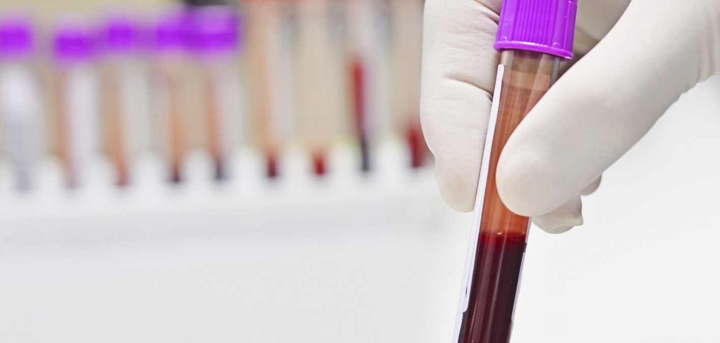 New HIV Drug Resistance Test Works With Undetectable Viral Load POZ